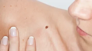 skin-cancer